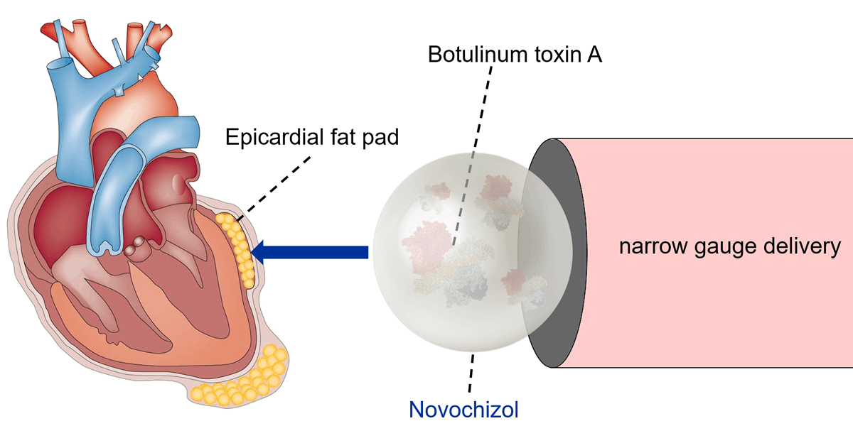 Atrial fibrillation (AF) is the most common type of arrhythmia