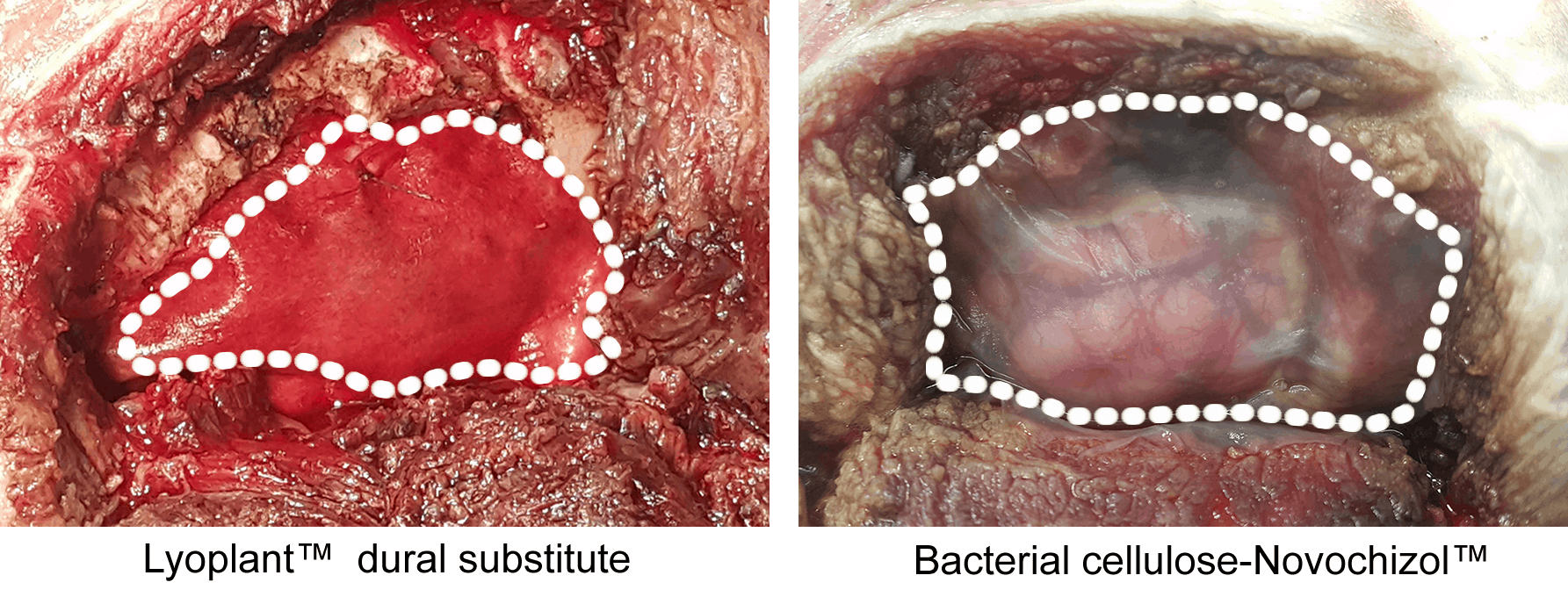 Duraplasty: Lyoplant™ dural substitute and bacterial cellulose - Novochizol TM